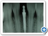 implant xray